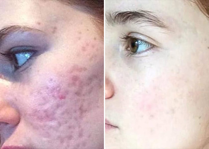 acne scar treatment