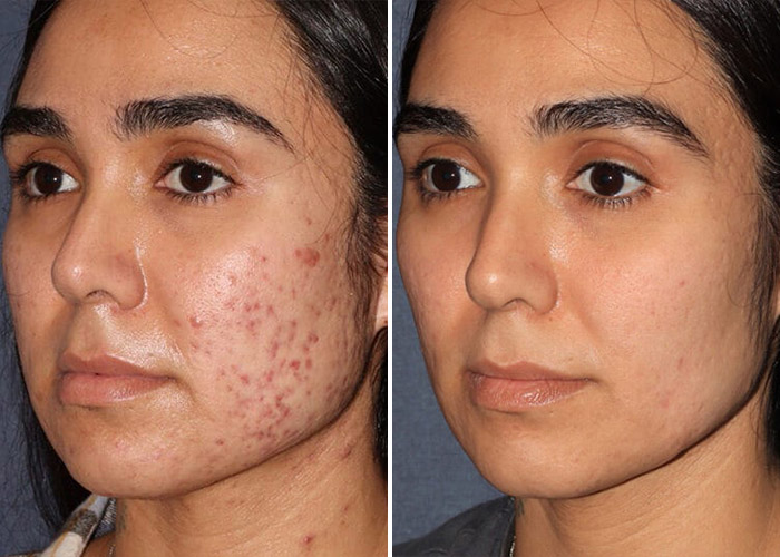acne scar treatment
