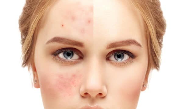 Different types of acne | How they are assessed and treated