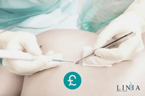 Mole Removal Cost - How Much Does it Cost to Remove Moles (Private and NHS)