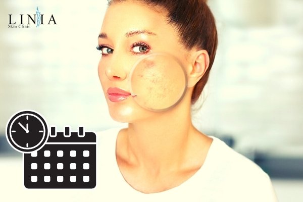 How Long Does It Take for Acne Scars to Fade? (Or Do They Last Permanently?)