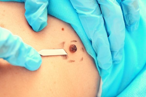 What Happens if You Accidentally Scratch off a Mole? - Century Medical &  Dental Center