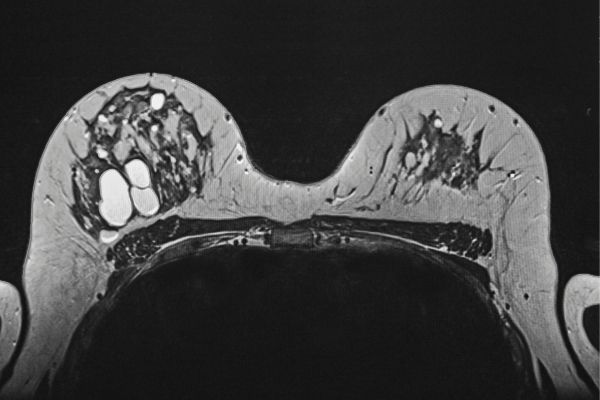 Can Cysts Be Removed without Surgery blog post image