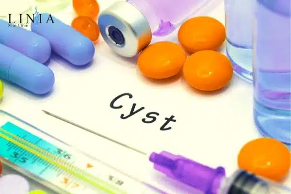 Can Cysts Be Removed without Surgery?