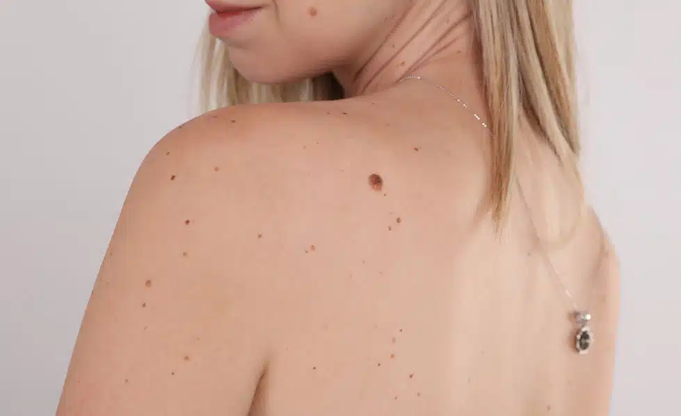 How to Remove Skin Tags (and Why Getting Rid at Home is a Bad Idea)