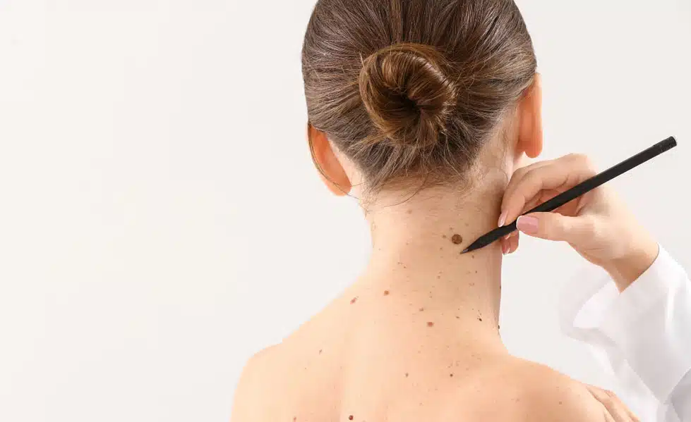 When Should You Get a Mole Removed?