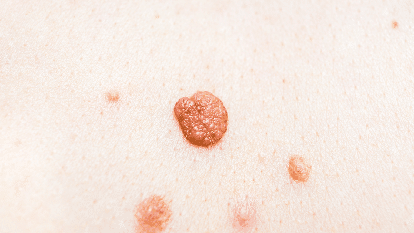 Mole Vs. Skin Tag: Understanding the Difference