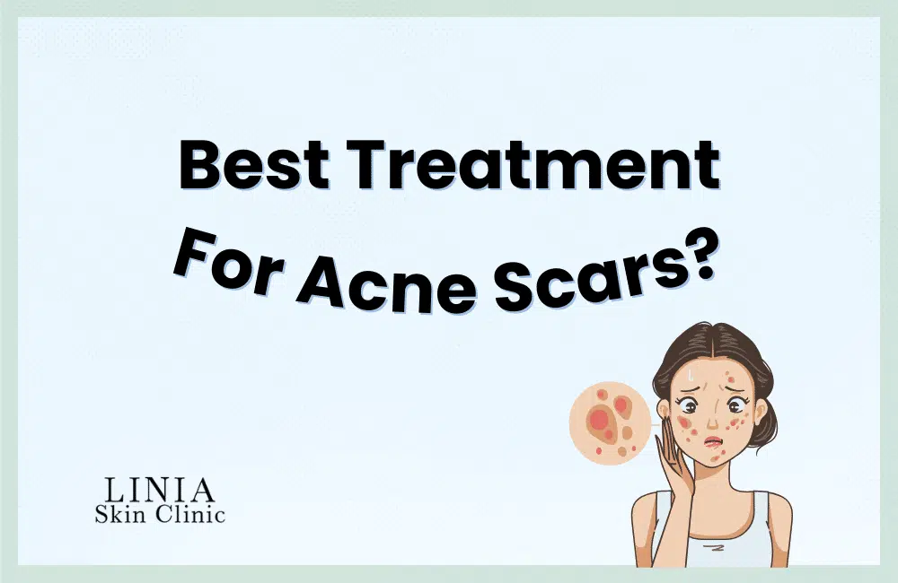 What is the best treatment for Acne Scars? Blog image