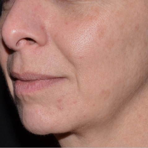 The World’s Most Advanced Thulium Laser at Linia Skin Clinic