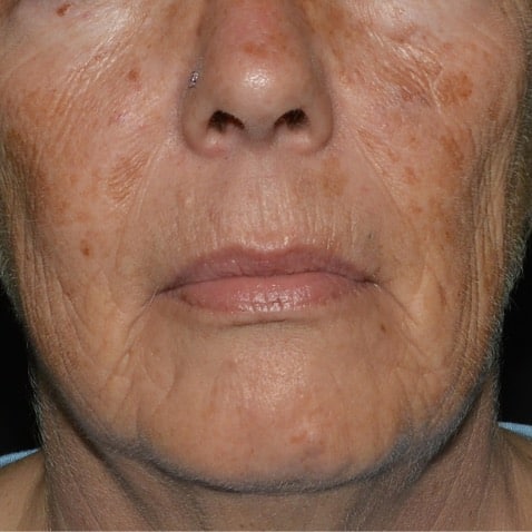 The World’s Most Advanced Thulium Laser at Linia Skin Clinic