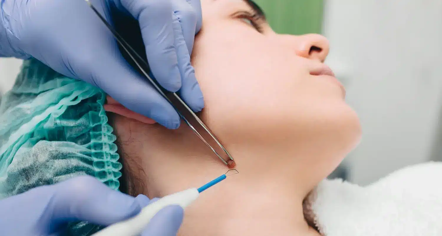 Clinician removing a small mole from the jawline of a woman lying on a treatment couch