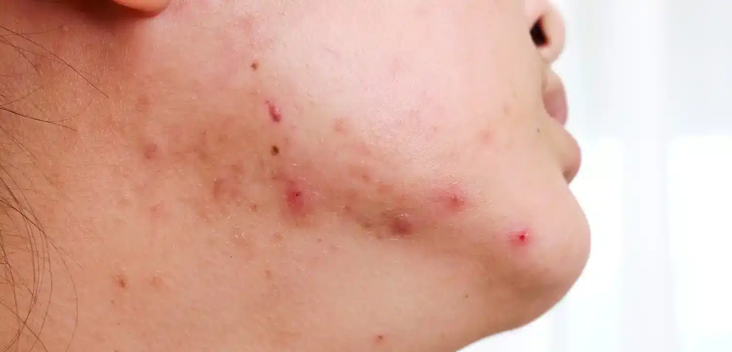 Chin acne — causes, treatment, and prevention