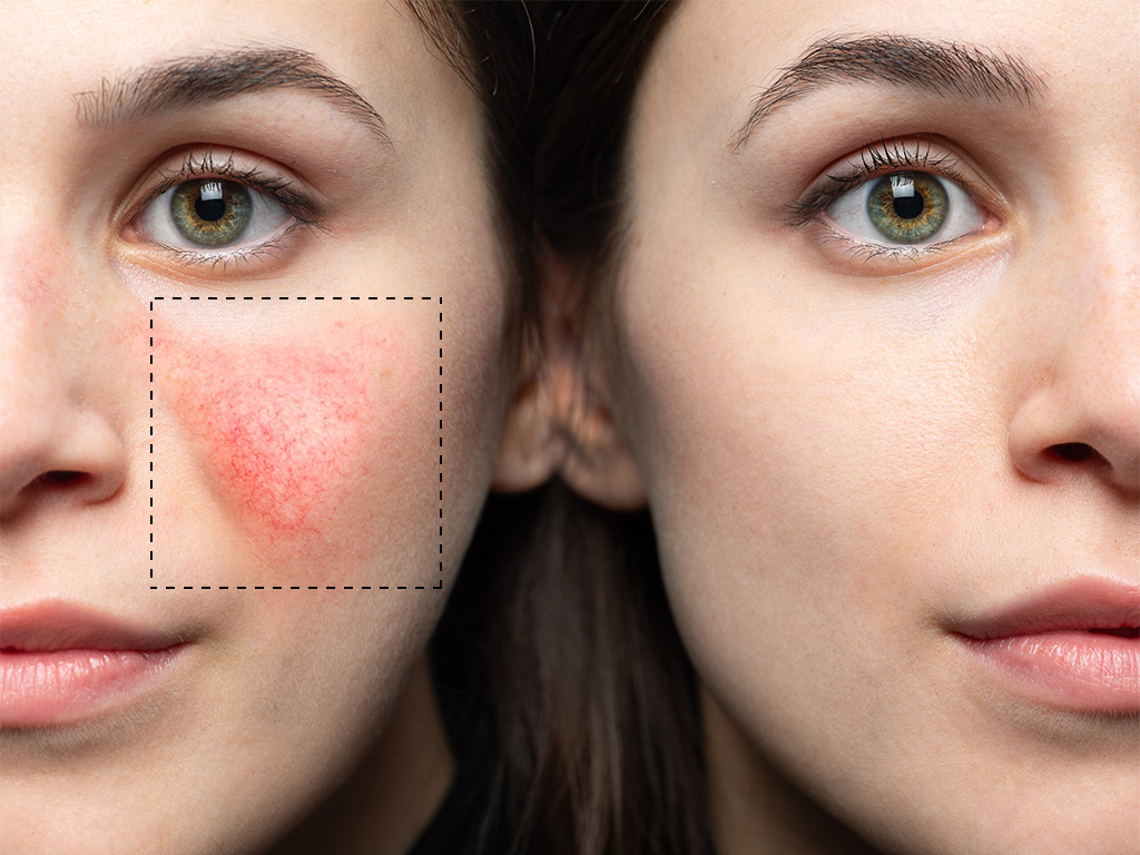 Actinic Keratosis