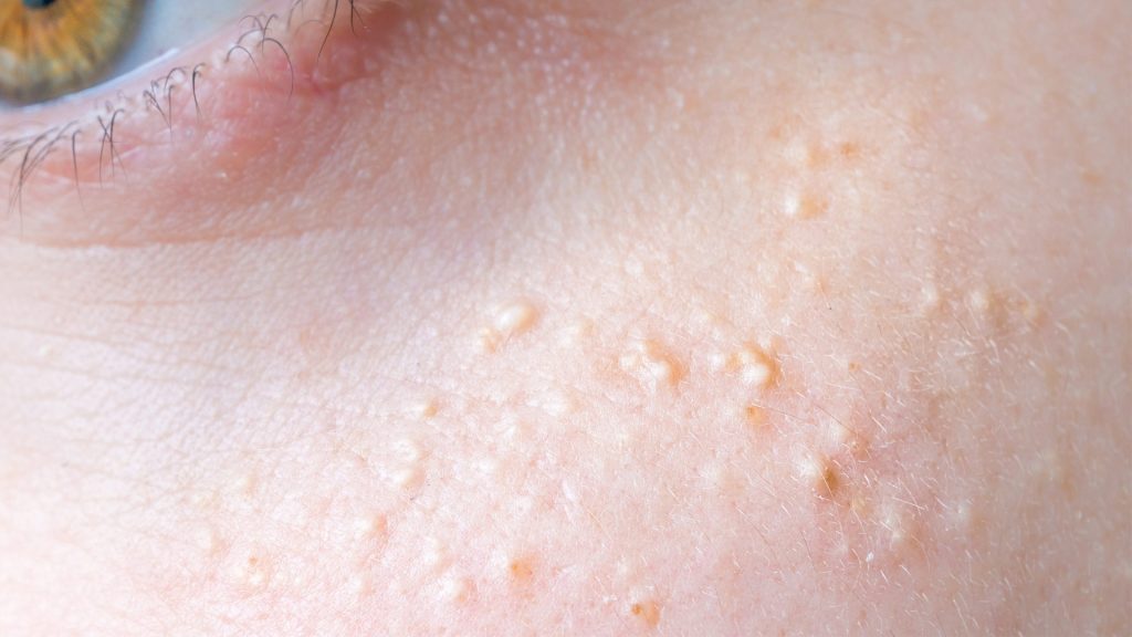 How to Get Rid of Milia Under Eyes