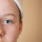 Acne Excoriée is a type of acne caused by repetitive picking of the skin, and this article explains its causes, symptoms, and treatment options.