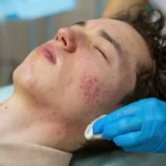 Learn how to understand, treat, and manage teen acne for clearer, healthier skin.