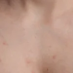 Understanding Chest Acne and the Most Effective Ways to Treat It