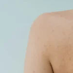 Learn How to Treat and Prevent Shoulder Acne Effectively