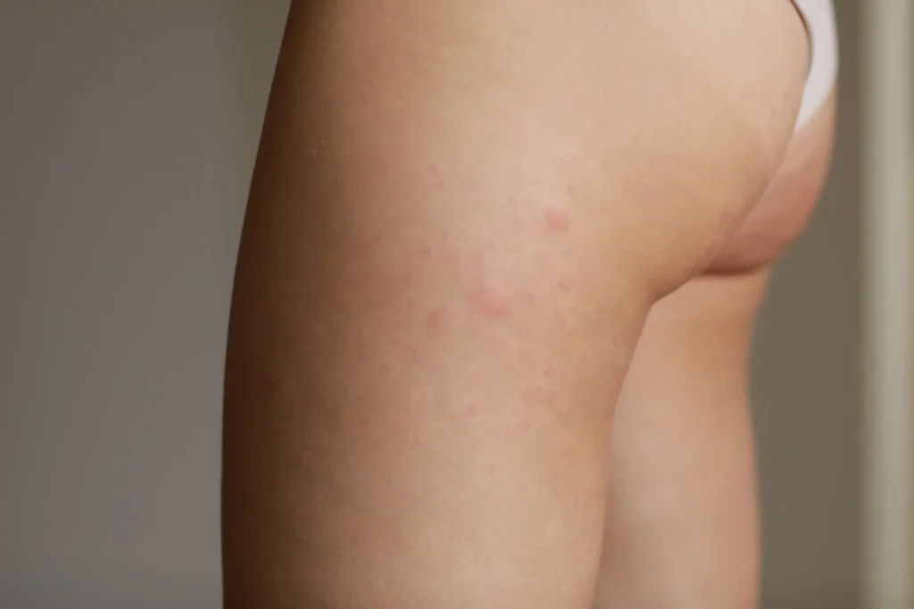 Understanding Butt Acne: How to Identify, Treat, and Prevent It for Healthy Skin