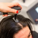 Everything You Need to Know About Scalp Acne: From Identifying Symptoms to Treating and Preventing Breakouts