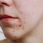 Understanding the Causes and Effective Treatments for Acne Around the Mouth