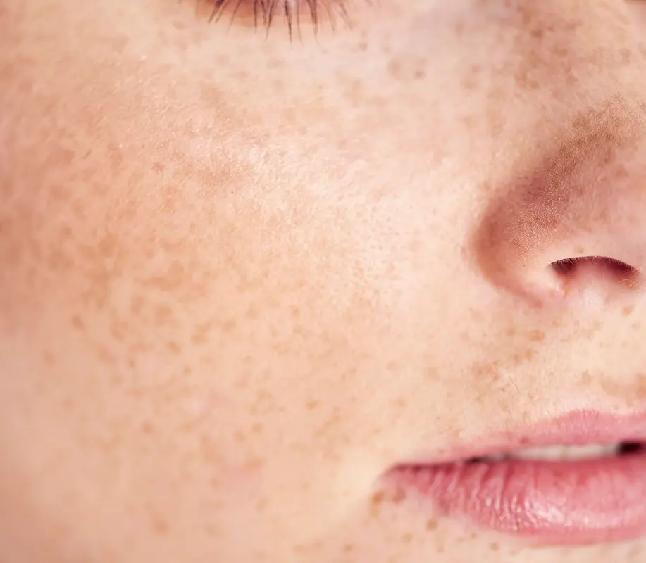 Skin Pigmentation Treatment & Lesions Removal