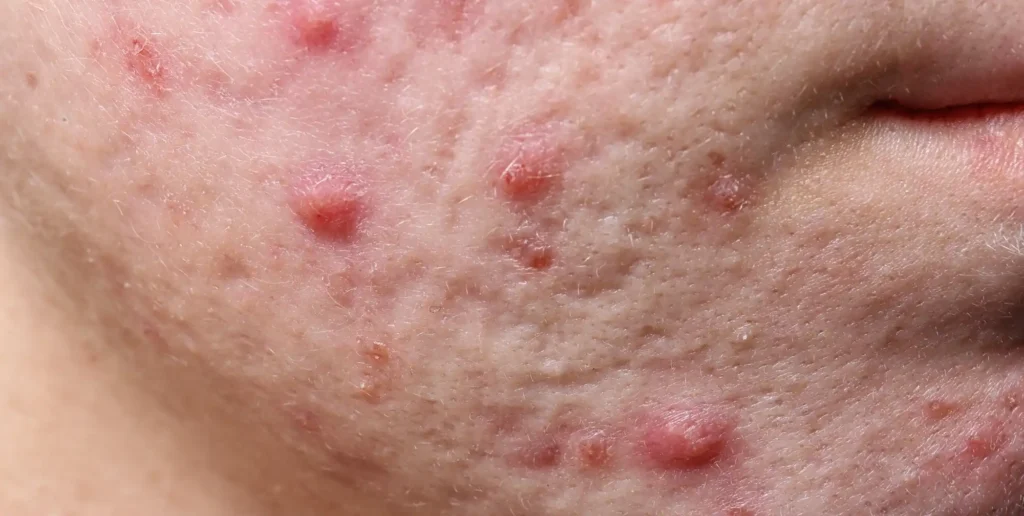 What You Need to Know About Cystic Acne and How to Treat It