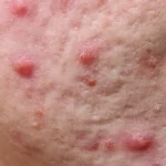 What You Need to Know About Cystic Acne and How to Treat It
