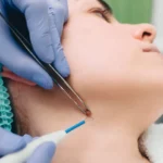 Face Cyst Removal