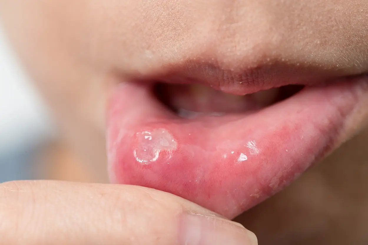Examining the inner surface of the lower lip, the most common site for an oral mucocele