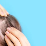 A Complete Guide to Pilar Cyst Removal and Treatment
