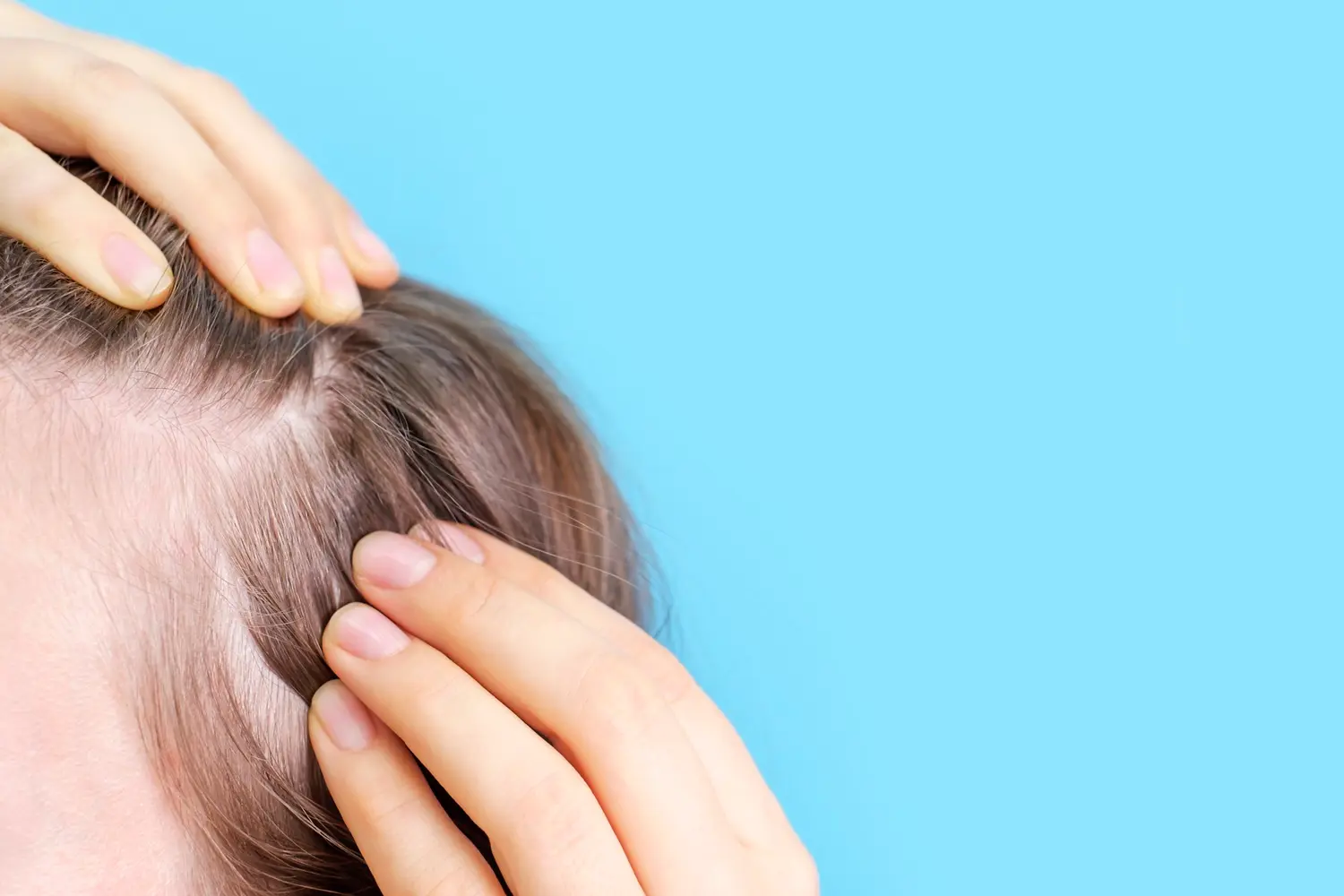 Parting the hair to examine the scalp, the site of around 90% of pilar cysts