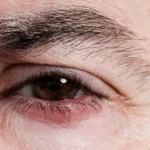 Everything you need to know about eyelid cyst removal, from diagnosis to recovery