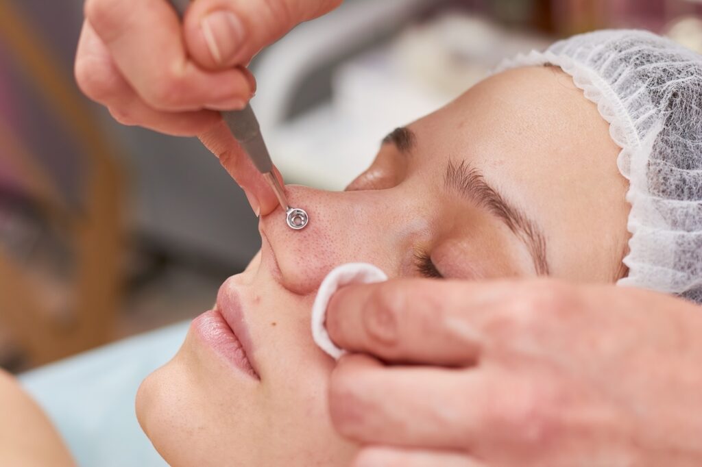 A complete guide to nose cysts and nose cyst removal