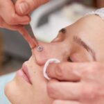 Clinician treating a small lump on the side of a woman's nose during a facial skin procedure